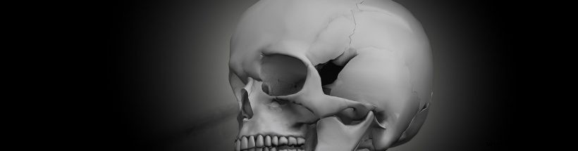 3Dプリント骨インプラントは標準治療になり得るか？